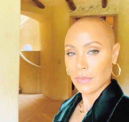 Jada has alopecia, a condition that causes her hair to fall out. (Photo: Instagram)