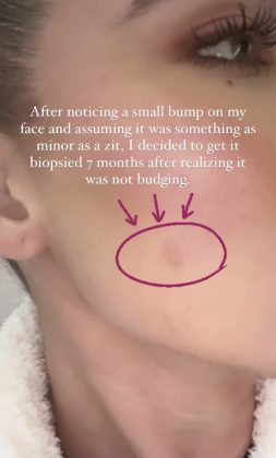 So she decided to go to a dermatologist and underwent two biopsies, and an “incredibly rare” tumor was detected for her age. (Photo: Instagram release)